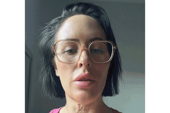 The gory social media trend fuelling a surge in cosmetic tourism in Turkey