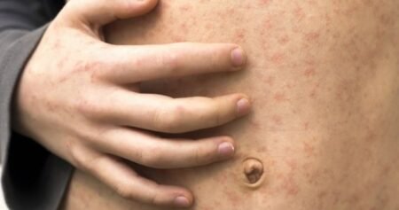 Measles surge boosts support for mandatory school vaccines: poll