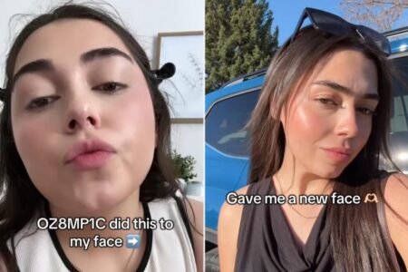 ‘Ozempic face’ might cause sagging skin — but one user loves her new look: ‘Like I got jawline filler’