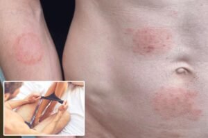 This sexually transmitted fungus causes ringworm in some very unfortunate places — and there’s an outbreak