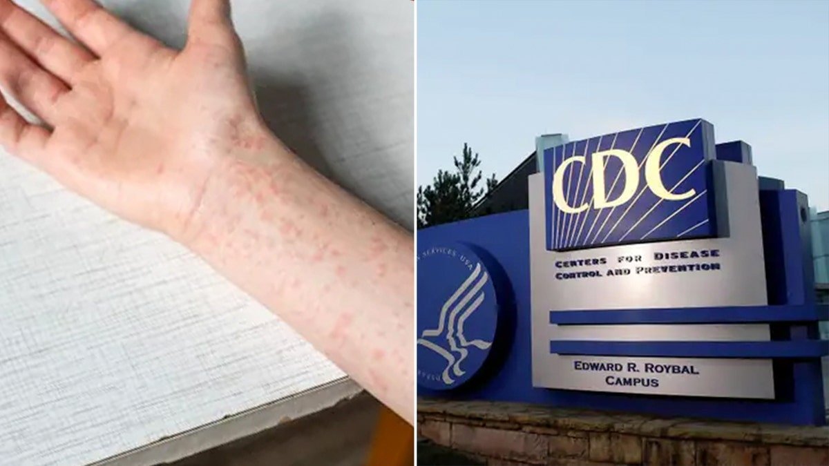 measles, cdc split photo