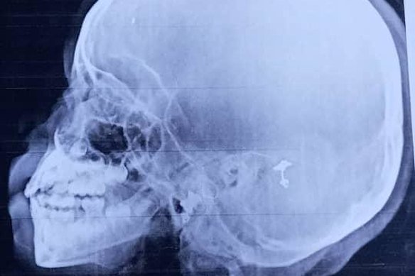 Doctors say the shrapnel in the head of Hodan Abby’s daughter needs to be removed.