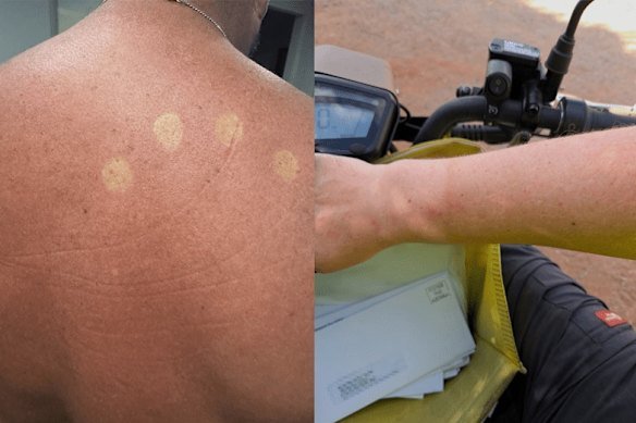 Australia Post workers’ sunburn while wearing the new polo shirts, which are supposed to be SPF 50‑rated.