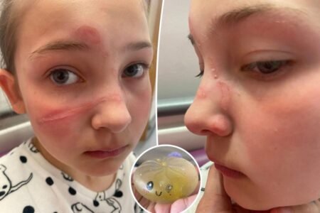 Authorities warn parents about dangerous TikTok challenge with popular children’s toy causes ‘traumatizing’ burns