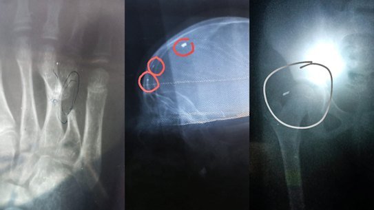 X-Rays that show the medical condition of Hodan Abby’s nine-year-old daughter. 