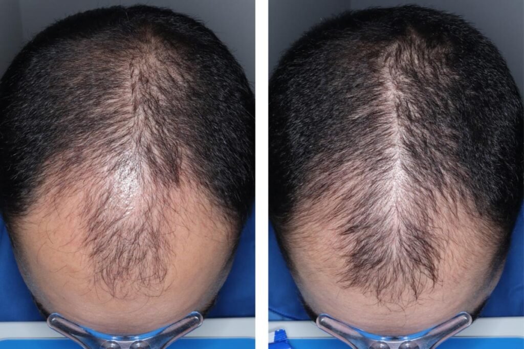 Experimental hair loss pill just cleared a major hurdle — when it could hit shelves