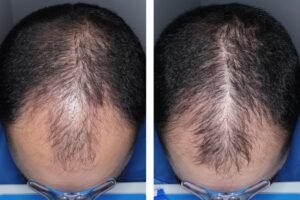 Experimental hair loss pill just cleared a major hurdle — when it could hit shelves