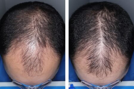 Experimental hair loss pill just cleared a major hurdle — when it could hit shelves