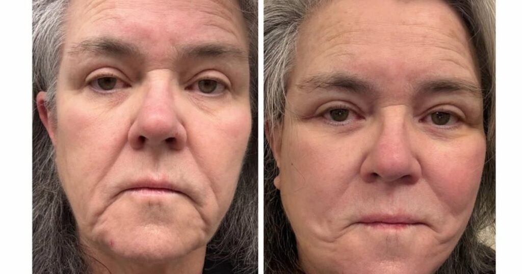 Rosie O’Donnell Shares Before-And-After Photos of Facelift 1 Day After Revealing Cosmetic Procedure Rosie O’Donnell Shares Before-And-After Photos of Facelift 1 Day After Revealing Cosmetic Procedure