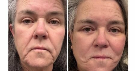 Rosie O’Donnell Shares Before-And-After Photos of Facelift 1 Day After Revealing Cosmetic Procedure Rosie O’Donnell Shares Before-And-After Photos of Facelift 1 Day After Revealing Cosmetic Procedure