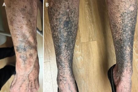 68-year-old woman’s arms and legs turn blue after taking very common drug