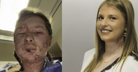 World-first burn treatment shows ‘remarkable’ results in Canadian patient World-first burn treatment shows ‘remarkable’ results in Canadian patient