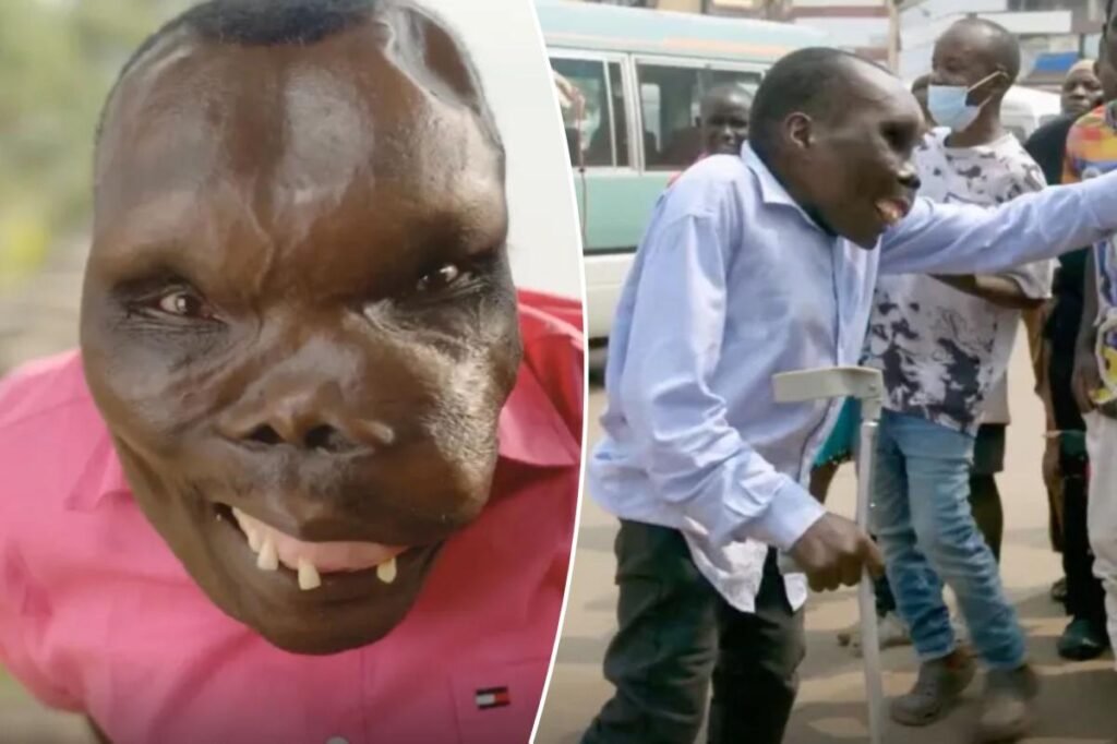 I’m the ‘world’s ugliest man’ — my rare disease turns my muscles and tissue into bone I’m the ‘world’s ugliest man’ — my rare disease turns my muscles and tissue into bone