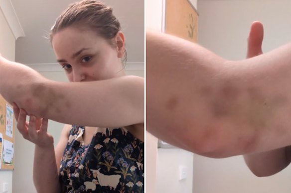 Carly Richardson said the police response to her suicide attempt left her with bruises.