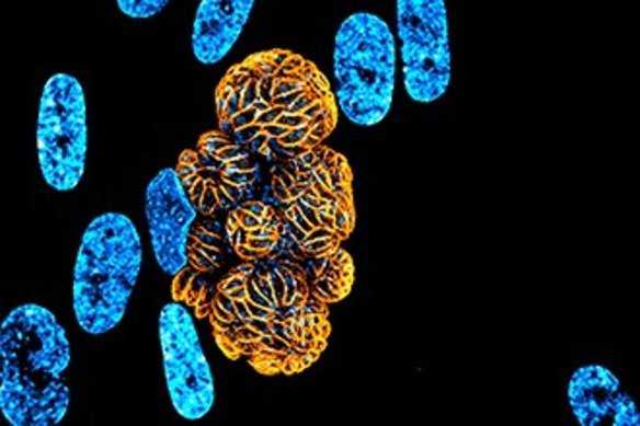 A Toxoplasma-infected human cell before it bursts.