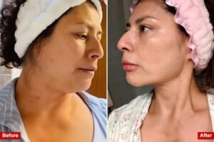 Exclusive | Meet the women performing at-home liposuction on themselves with shady kits to shed weight Exclusive | Meet the women performing at-home liposuction on themselves with shady kits to shed weight