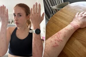 Travel influencer riddled with bleeding bed bug bites after one-night stay at popular international hotel: ‘Wouldn’t wish this on my worst enemy’ Travel influencer riddled with bleeding bed bug bites after one-night stay at popular international hotel: ‘Wouldn’t wish this on my worst enemy’