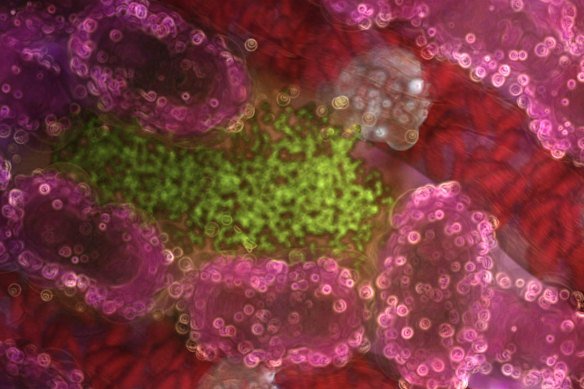 Illustration of liver cells (pink) infected with a malaria parasite (green). Malaria lurks and multiplies in the liver before attacking red blood cells.