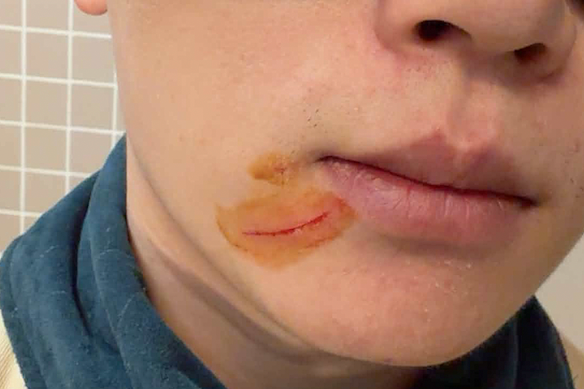 Lenny Tai’s alleged scratches after the incident.