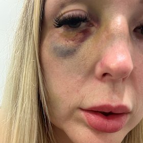 Chloe Wright needed surgery after the attack.