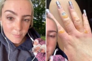 NYC woman warns against getting painful, blistering ‘Margarita Burn’ by avoiding this common summer activity NYC woman warns against getting painful, blistering ‘Margarita Burn’ by avoiding this common summer activity
