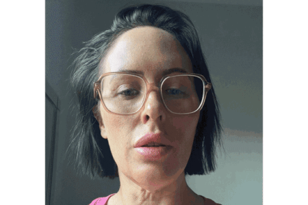 The gory social media trend fuelling a surge in cosmetic tourism in Turkey The gory social media trend fuelling a surge in cosmetic tourism in Turkey
